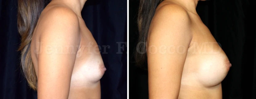 Augmentation Mammoplasty in Dallas, TX - Case H - Right Side