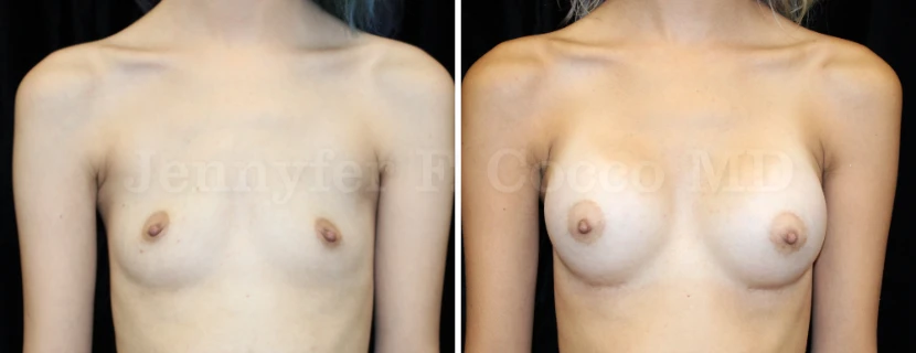 Augmentation Mammoplasty in Dallas, TX - Case I - Front