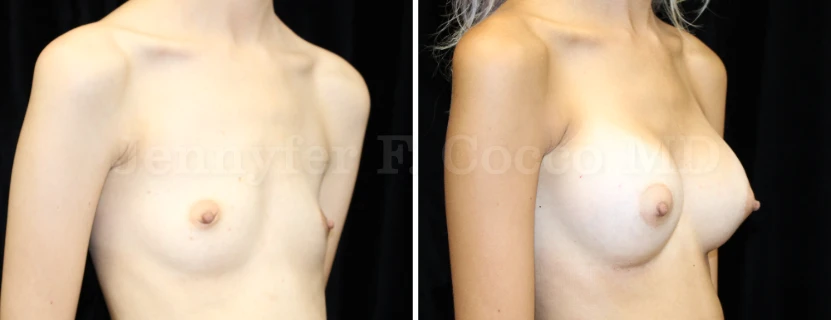 Augmentation Mammoplasty in Dallas, TX - Case I - Right Oblique