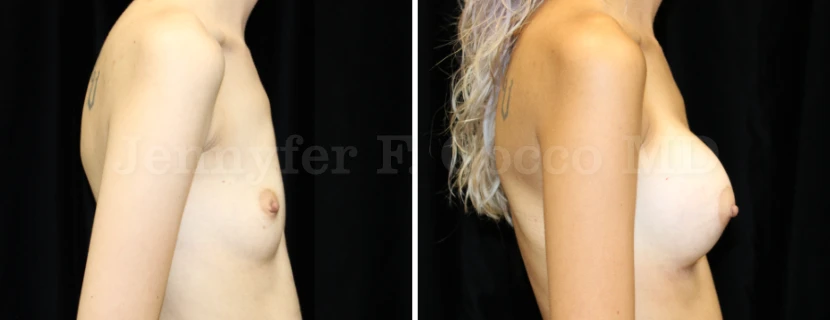Augmentation Mammoplasty in Dallas, TX - Case I - Right