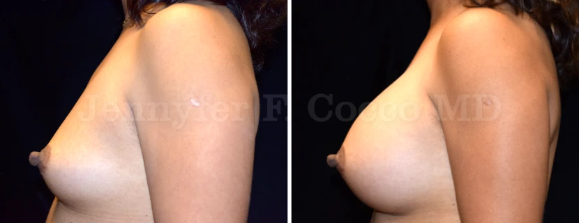 Augmentation Mammoplasty in Dallas, TX - Case J - Left