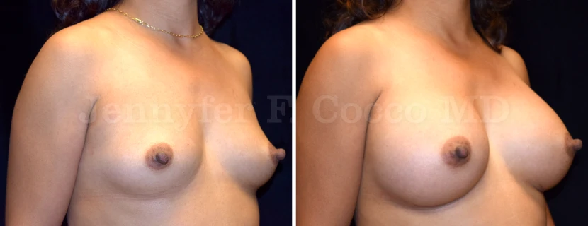 Augmentation Mammoplasty in Dallas, TX - Case J - Right Oblique