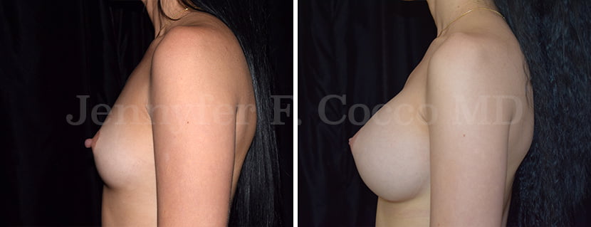 Augmentation with MemoryGel Implants - Case E - Left Side