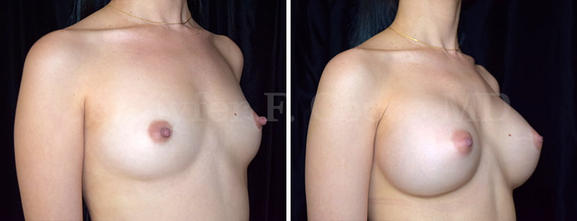 Augmentation with MemoryGel Implants - Case E - Right Oblique