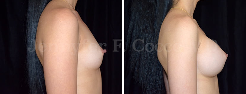 Augmentation with MemoryGel Implants - Case E - Right Side