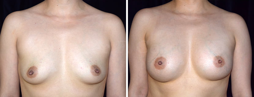 Breast Augmentation in Dallas, TX - Case A - Frontal View