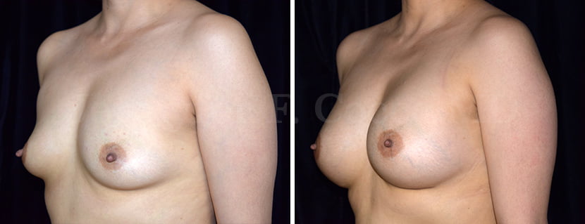 Breast Augmentation in Dallas, TX - Case A - Left Oblique