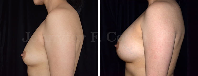 Breast Augmentation in Dallas, TX - Case A - Left Side