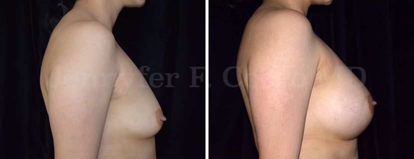 Breast Augmentation in Dallas, TX - Case A - Right Side