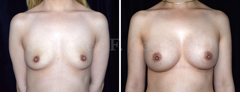 Breast Augmentation in Dallas, TX - Case B - Frontal View