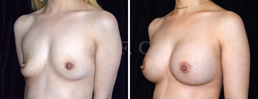Breast Augmentation in Dallas, TX - Case B - Left Oblique