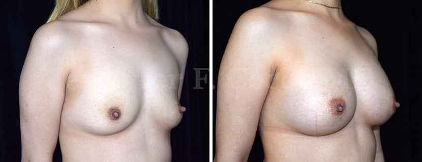 Breast Augmentation in Dallas, TX - Case B - Right Oblique