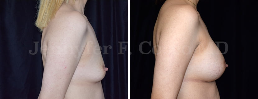 Breast Augmentation in Dallas, TX - Case B - Right Side