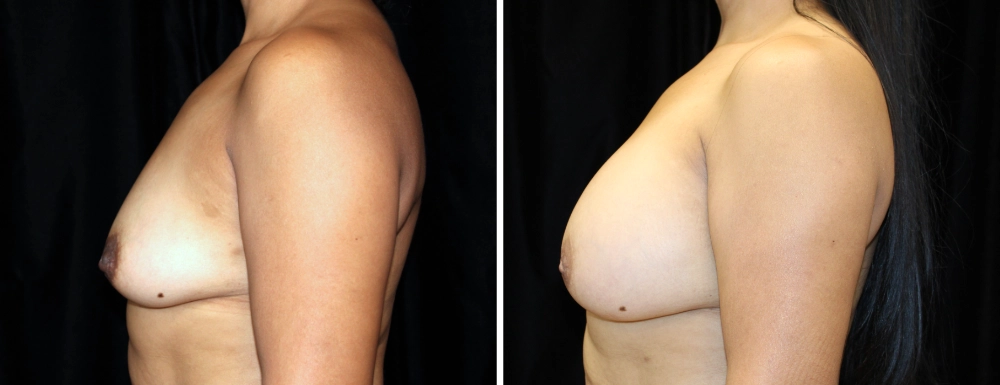 Breast Augmentation in Dallas, TX - Case H - Left