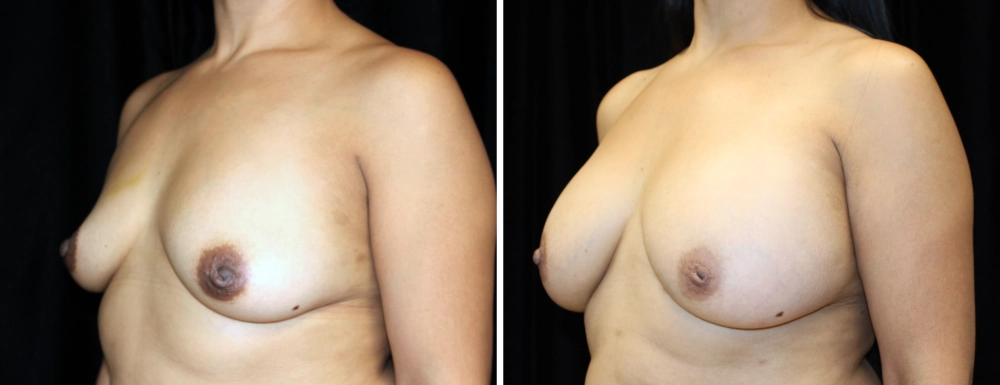 Breast Augmentation in Dallas, TX - Case H - Left Oblique