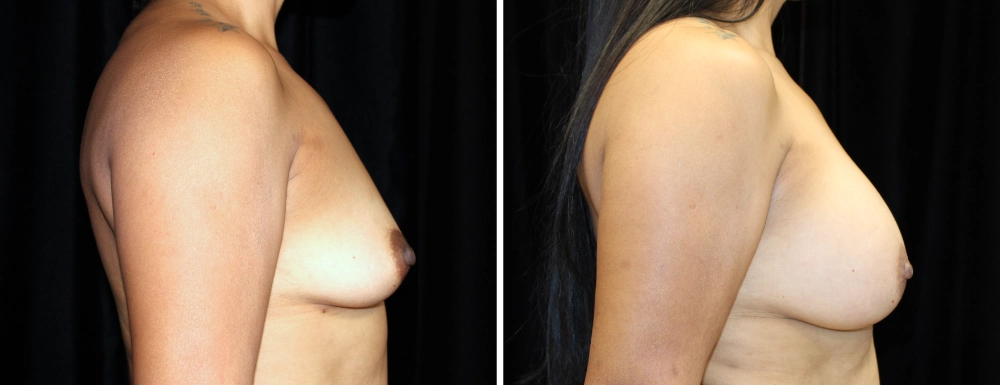 Breast Augmentation in Dallas, TX - Case H - Right