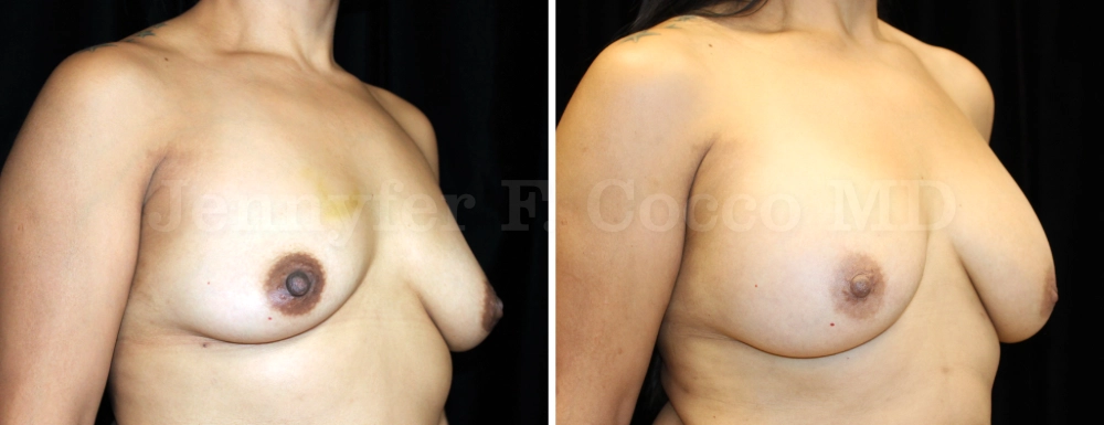 Breast Augmentation in Dallas, TX - Case H - Right Oblique