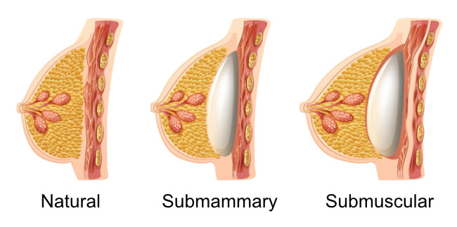 Breast Implant Placement Breast Implant Placement