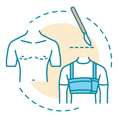 Breast Reduction for Men - Gynecomastia