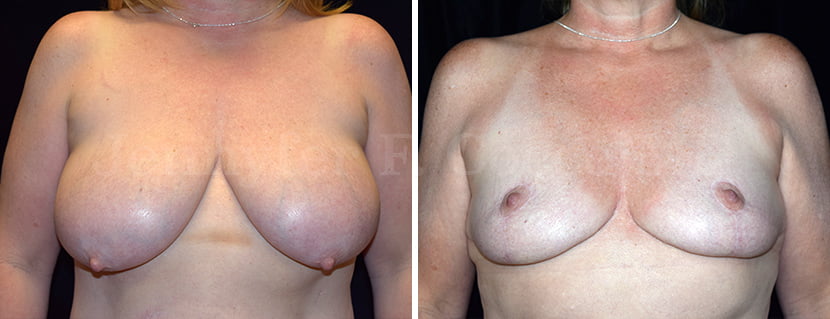 Breast Reduction Case A - Frontal