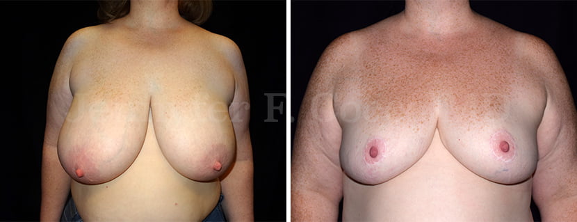 Mammoplasty Case B - Frontal