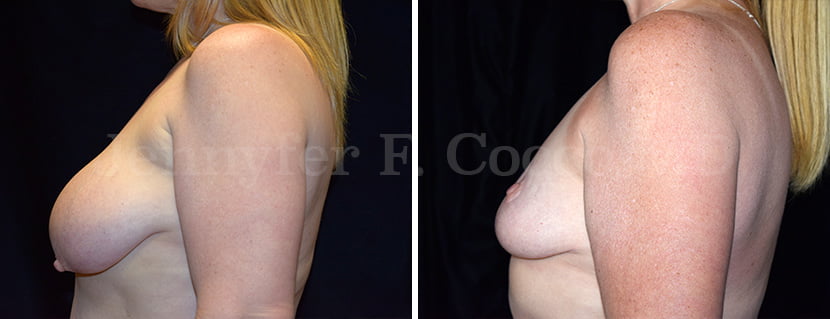 Breast Reduction Case A - Left Side
