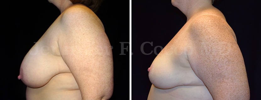 Mammoplasty Case B - Left Side