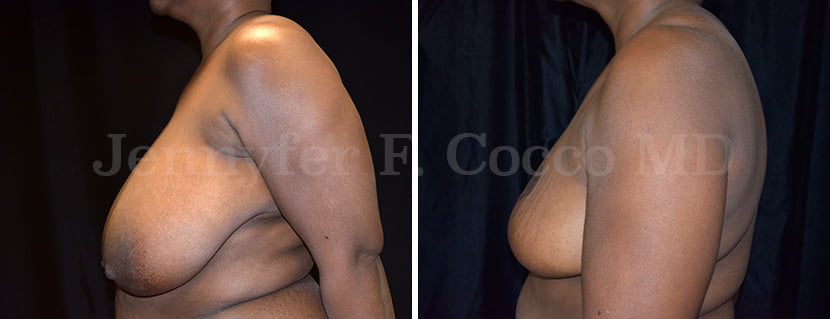 Breast Reduction Case C - Left Side