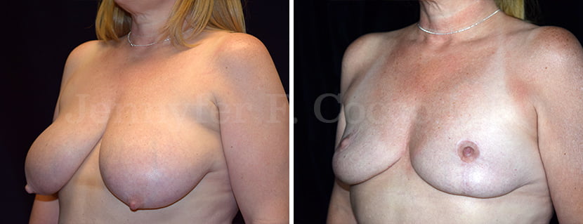Breast Reduction Case A - Left Oblique
