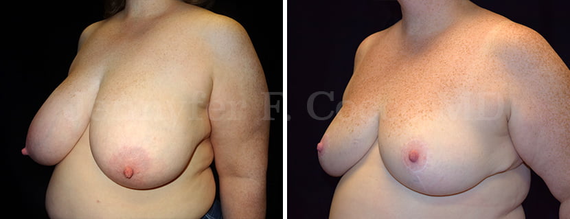 Mammoplasty Case B - Left Oblique