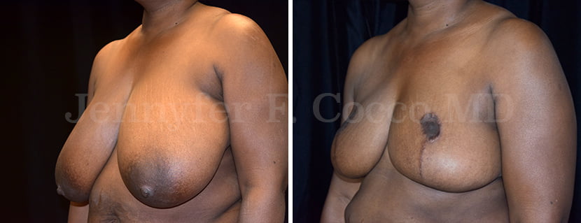 Breast Reduction Case C - Left Oblique