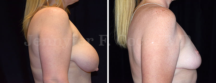 Breast Reduction Case A - Right Side
