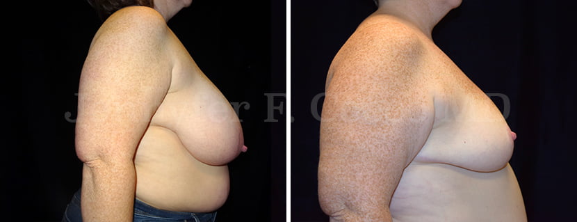 Mammoplasty Case B - Right Side