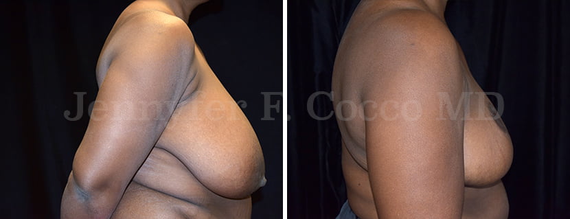 Breast Reduction Case C - Right Side