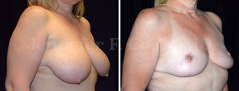 Breast Reduction Case A - Right Oblique