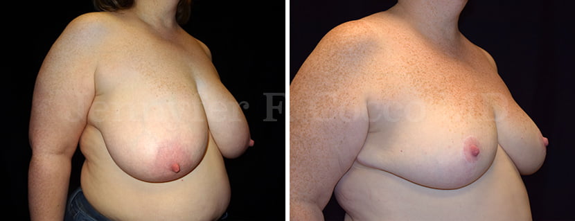 Mammoplasty Case B - Right Oblique