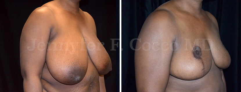 Breast Reduction Case C - Right Oblique