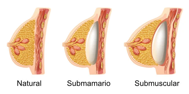 Colocacion de los implantes de senos
