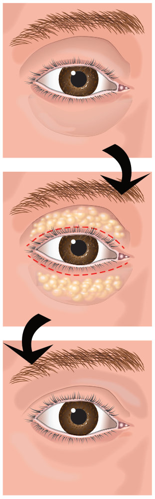Combined Blepharoplasty - Upper and Lower Eyelid Surgery