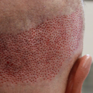 SmartGraft Donor Area Holes 