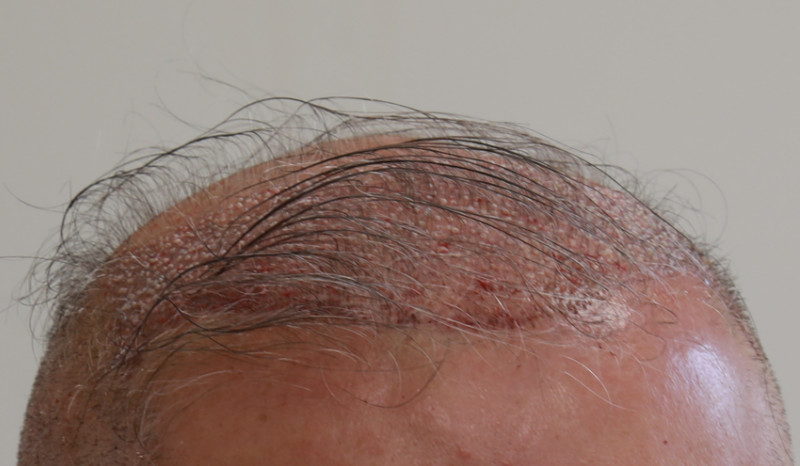 Implanted Hair Grafts