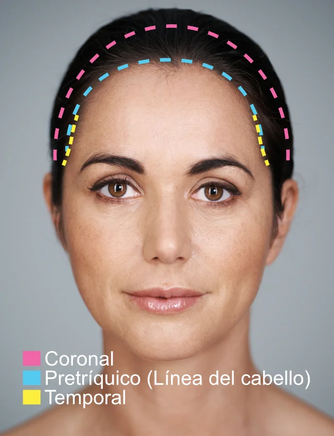 Incisiones del levantamiento de cejas