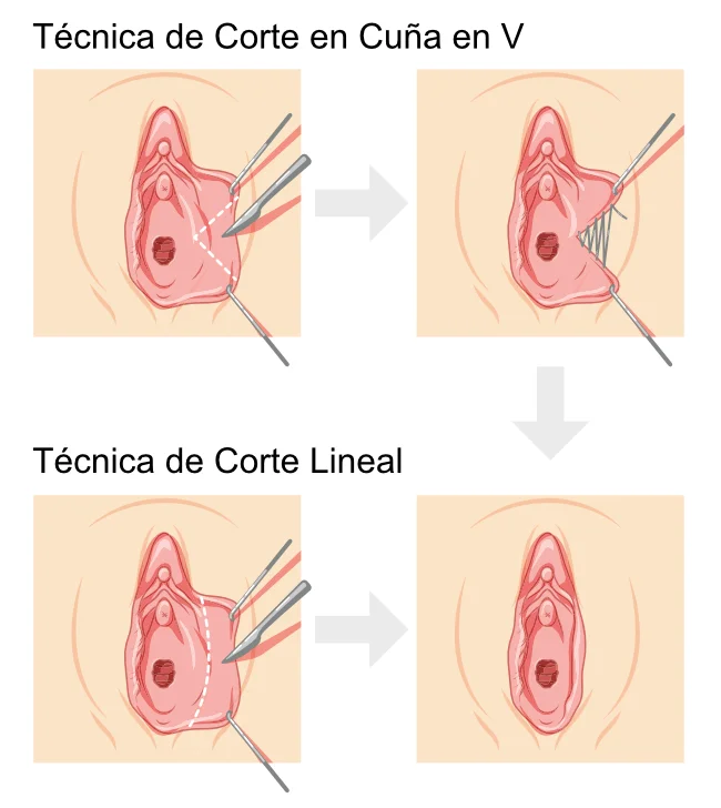 Técnicas de Labioplastia - Corte Lineal y Cuña en V Técnicas de Labioplastia - Corte Lineal y Cuña en V