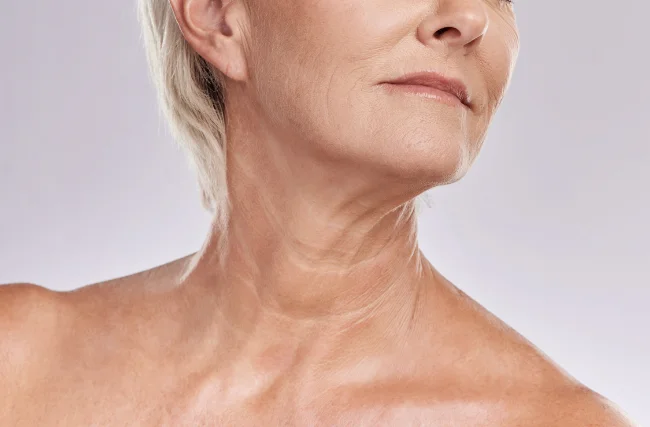 Liposucción de Cuello con Platismoplastia