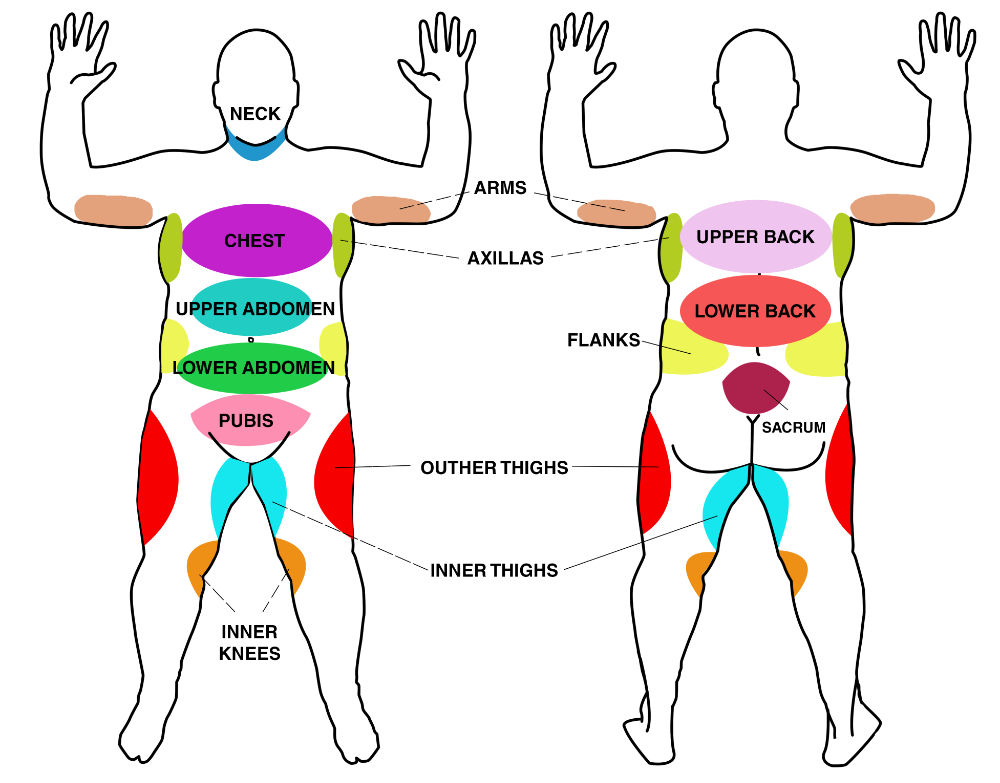 Liposuction Treatment Areas - Diagram