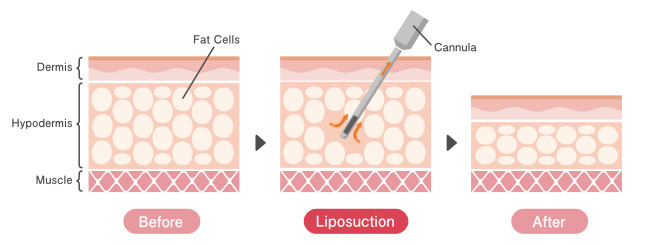 Liposuction Process - Dallas, TX