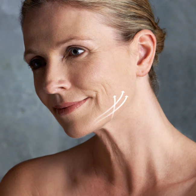 Lower Facelift in Dallas, TX - Jowl Lift