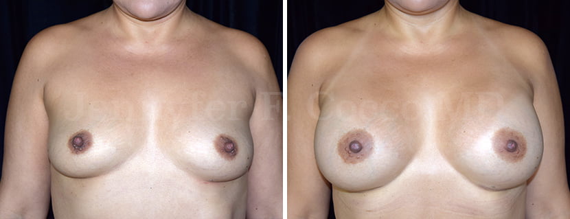 Mammoplasty with Implants in Dallas, TX - Case F - Frontal View