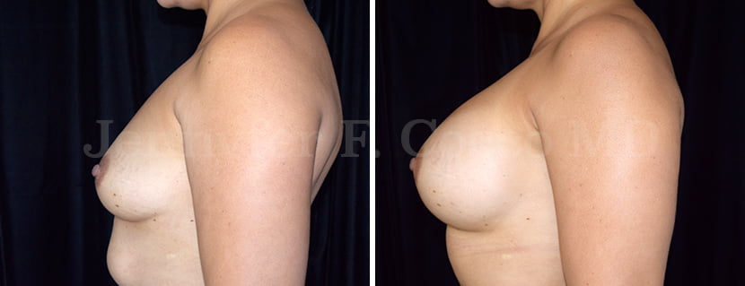 Mammoplasty with Implants in Dallas, TX - Case F - Left Side