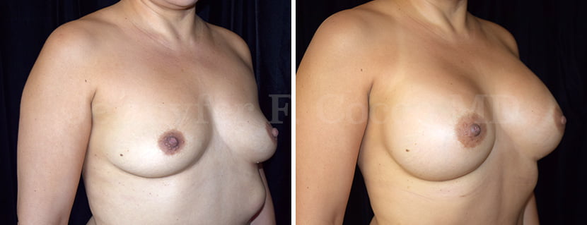 Mammoplasty with Implants in Dallas, TX - Case F - Right Oblique
